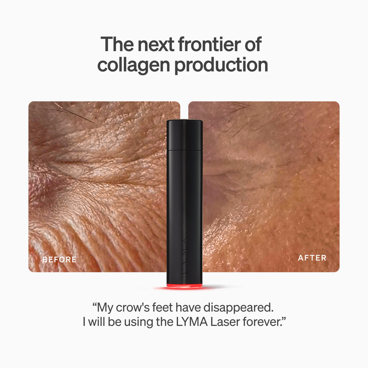 The LYMA Laser - LYMA's breakthrough cold laser technology. Engineered to make you look younger.
