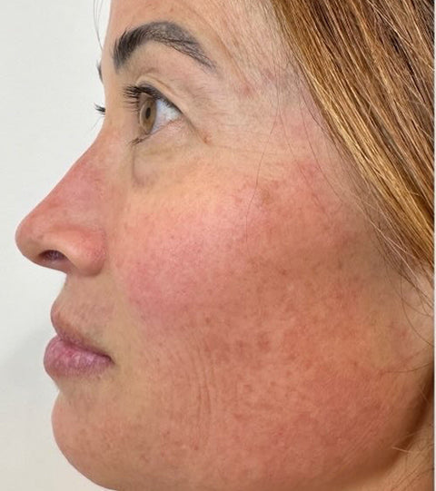 The LYMA Laser PRO - LYMA's breakthrough cold laser technology. Younger skin. Bigger lens. Faster results.