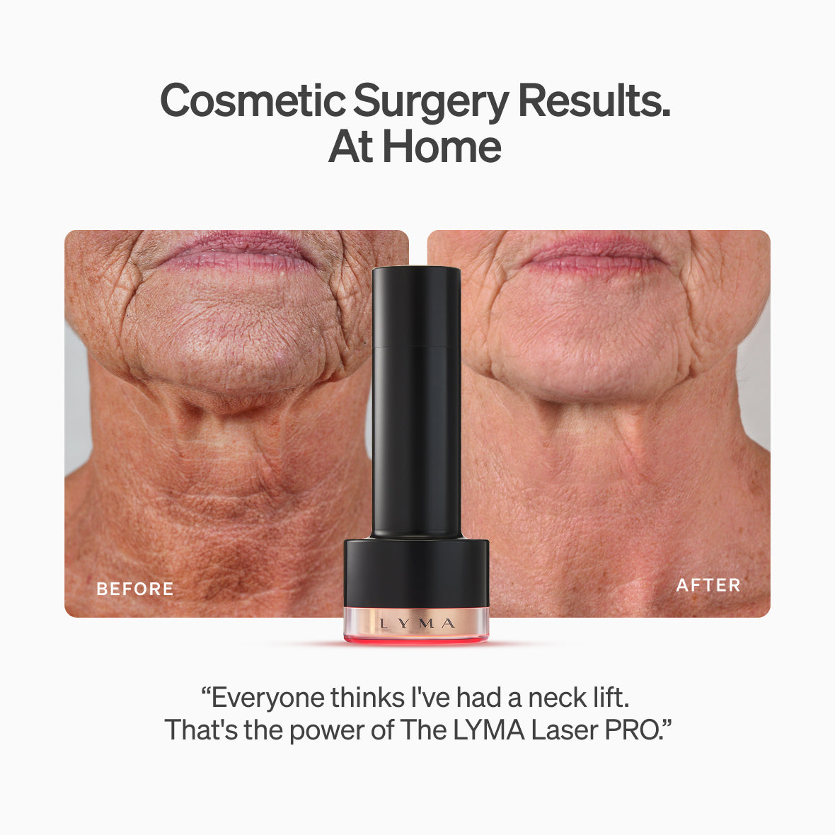 The LYMA PRO Youth System - Tighter jawline. Fewer wrinkles. Firmer neck. This is what happens when three technologies are engineered as one anti-aging system.