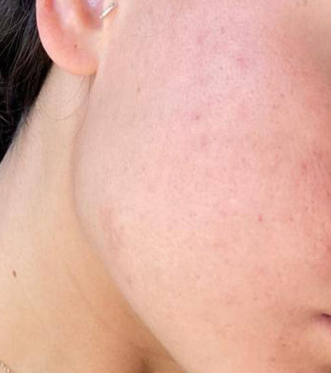 The LYMA Laser - LYMA's breakthrough cold laser technology. Engineered to make you look younger.