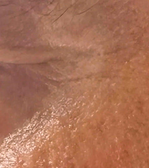 The LYMA Laser - LYMA's breakthrough cold laser technology. Engineered to make you look younger.