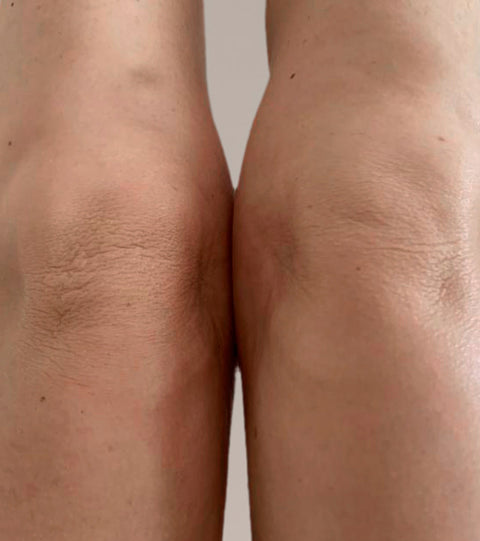 The LYMA Laser - LYMA's breakthrough cold laser technology. Engineered to make you look younger.