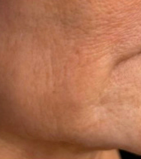 The LYMA Laser - LYMA's breakthrough cold laser technology. Engineered to make you look younger.