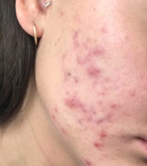 The LYMA Laser - LYMA's breakthrough cold laser technology. Engineered to make you look younger.