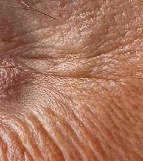 The LYMA Laser - LYMA's breakthrough cold laser technology. Engineered to make you look younger.