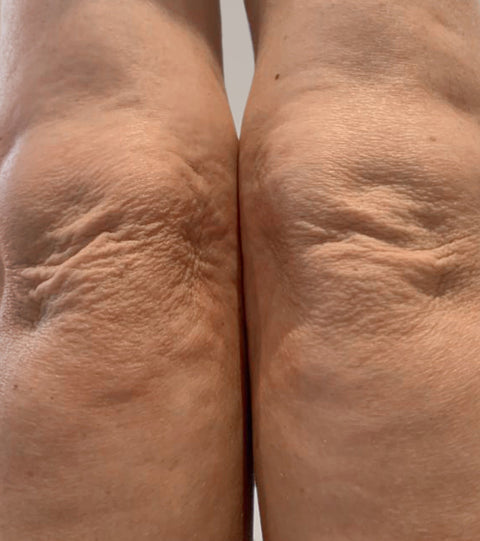 The LYMA Laser - LYMA's breakthrough cold laser technology. Engineered to make you look younger.