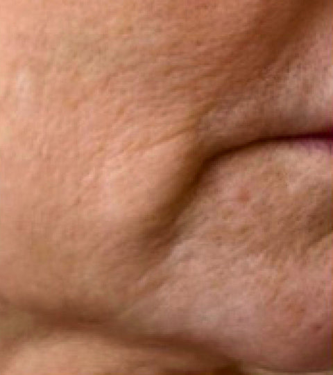 The LYMA Laser - LYMA's breakthrough cold laser technology. Engineered to make you look younger.