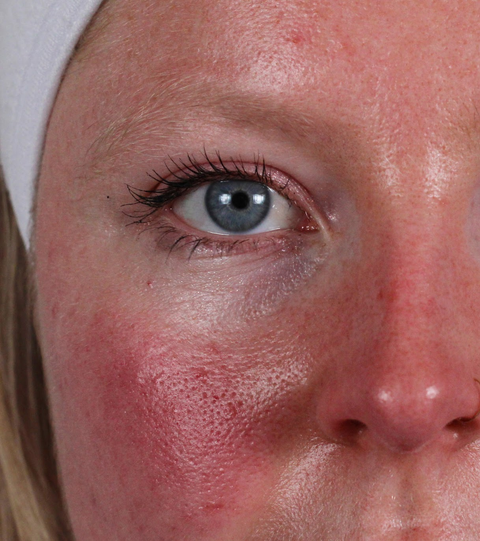 The LYMA Laser PRO - LYMA's breakthrough cold laser technology. Younger skin. Bigger lens. Faster results.