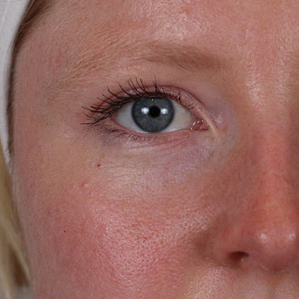 The LYMA Laser PRO - LYMA's breakthrough cold laser technology. Younger skin. Bigger lens. Faster results.